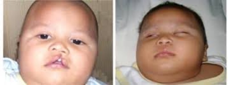 Gratis, Operasi Bibir Sumbing RSKB Jatiwinangun